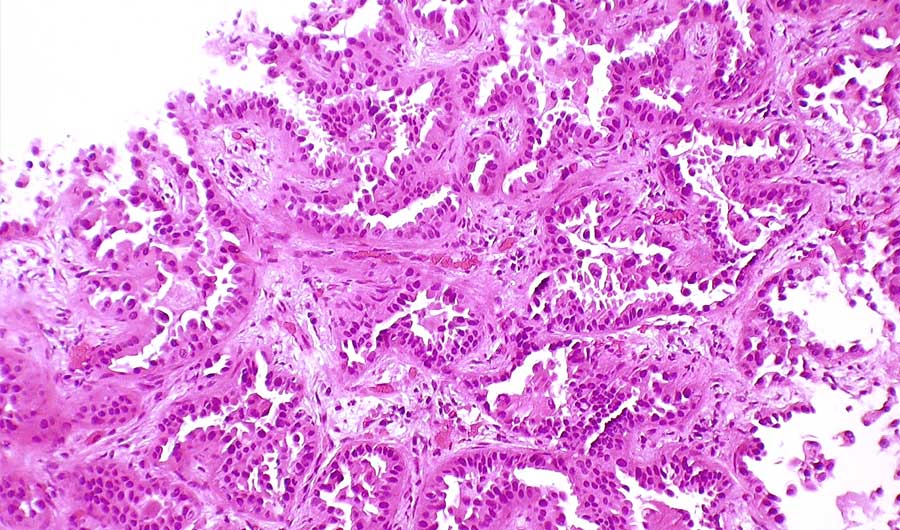 Lung cancer biopsy image.